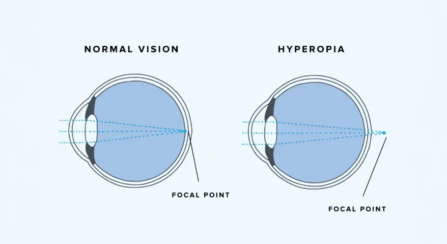 What Is Farsightedness