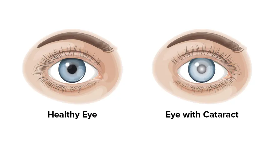 What Are Cataracts? Symptoms, Causes, and Treatment