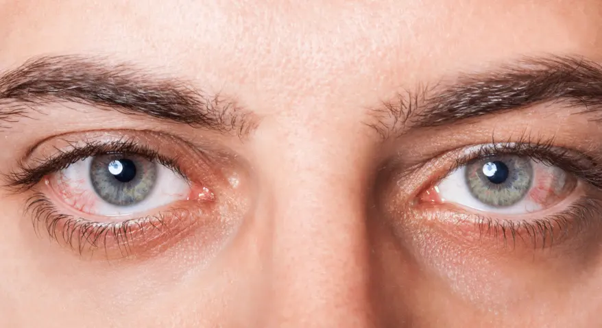 How to get rid of red eyes