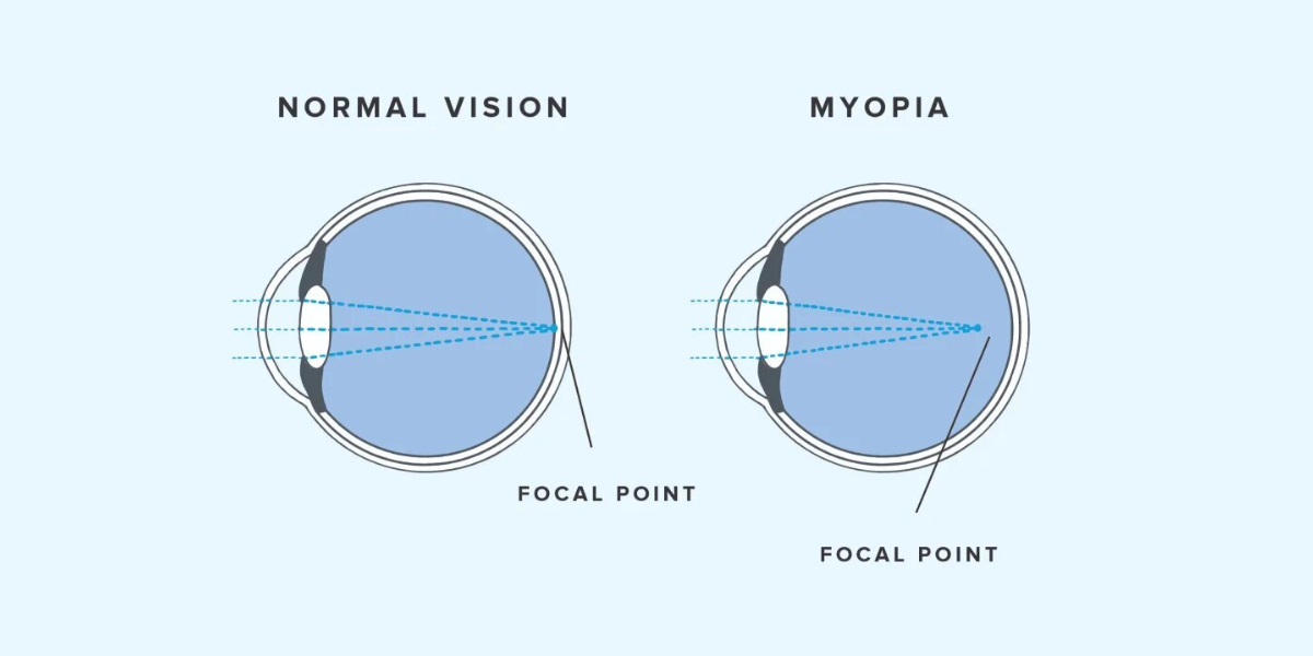 A schematic diagram comparing normal vision with myopia, illustrating how light focuses in front of the retina in a myopic eye.
