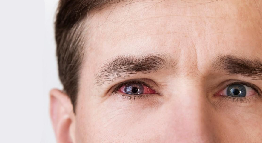 A man was looking closely at the screen, revealing both eyes, one of which had a red sclera.