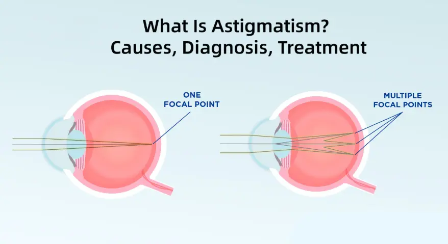 A schematic diagram illustrating the principles of astigmatism, contrasting the single focal point of a normal eye with the multiple focal points of an astigmatic eye.