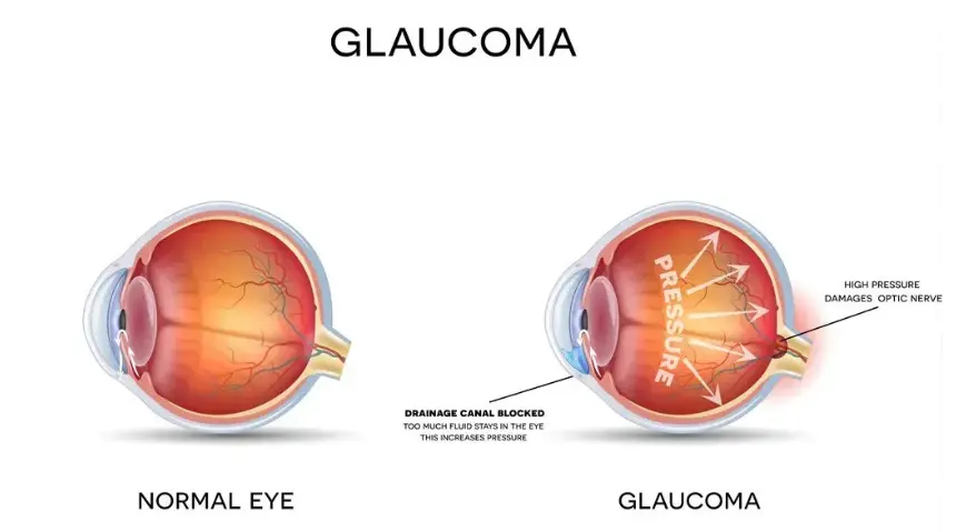 Glaucoma Illustration: A comparative display of the structures of a normal eye and an eye with glaucoma.